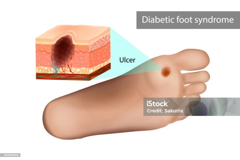 feet diabetic ulcer