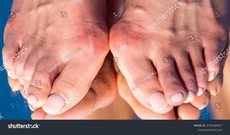 feet toe bunyon or arthrits. toe